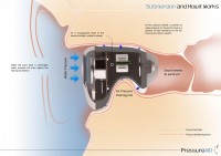 PressureAID-5